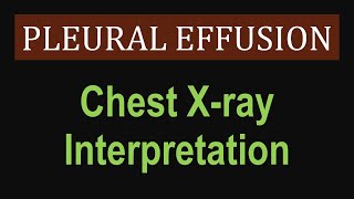 Pleural Effusion  Chest Xray Interpretation [upl. by Acnaib]