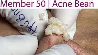 Acne Treatment Huong Da Nang 051  weekend  2023 [upl. by Lledniuq]