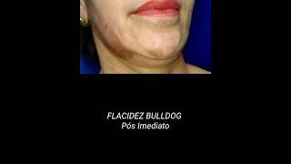 Redução da Flacidez Bulldog [upl. by Annekahs]