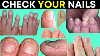 9 Alarming Signs Your Nails Are Warning You About Your Health [upl. by Nylassej824]