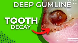 108 Deep Gumline Tooth Decay Restoration [upl. by Irap573]