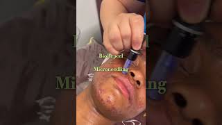 BioRepeel  Microneedling for acne💚 [upl. by Rdnaskela]