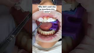 Composite Bonding time dentist dentalmakeover dentalrestoration [upl. by Nnylsia752]