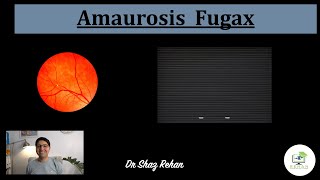 Amaurosis Fugax What is it What Causes it Will I go Blind How is it Treated I Dr Rehan 2021 [upl. by Koressa]