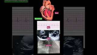 Normal ECG ECHO Angiography  Normal Heart Animation echo  short  video ▶️ [upl. by Ashwell]