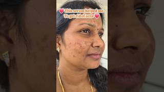 How to get rid of acne acne acneproneskin skincare skincareroutine [upl. by Einahc]