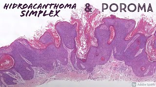 Poroma amp Hidroacanthoma Simplex dermatopathology dermatology pathology sweat gland tumors [upl. by Elokkin840]