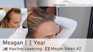 Female Hairline Lowering Hair Transplant 1 Year After  Dr Matt Huebner Meagan [upl. by Almeeta]