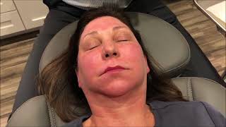 Laser Skin Tightening and Lower Eyelid 20 TCA Peel [upl. by Crow]