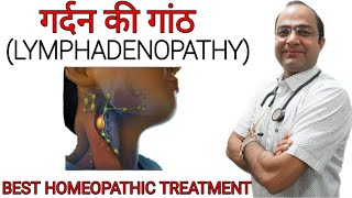 Swollen lymph nodes  Lymphadenopathy  गर्दन की गाँठ  Neck nodes swelling [upl. by Ahsein]