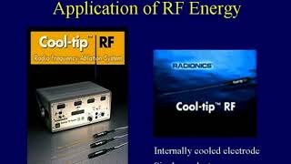 RFA in the Treatment of Lung Neoplasms [upl. by Nwahs]