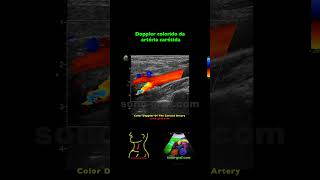 Duplex Sonografia  Estenose leve da artéria carótida interna [upl. by Ahsiuqat]