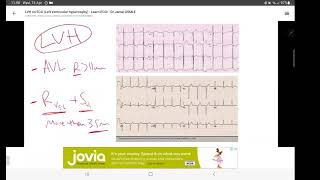 Pediatric ECG Basics 2 محاضرة شرح تخطيط القلب في الأطفال [upl. by Samanthia]