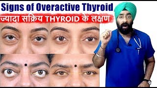 Rx Thyroid 4 Hindi ज्यादा सक्रिय थाइरोइड के लक्षण  Hyperthyroidism  DrEducation [upl. by Alonso]