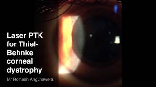 Laser PTK for Anterior Stromal Corneal Dystrophy [upl. by Brinson]