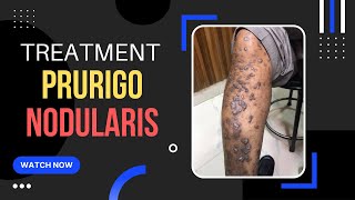 Prurigo Nodular Eczema Treatment ITCHY Skin bump एक्जिमा इलाज Dr Uttam Lenka [upl. by Ebehp]