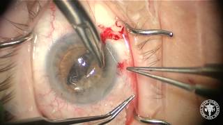 Iris Sutured IOL Basics [upl. by Opportina]