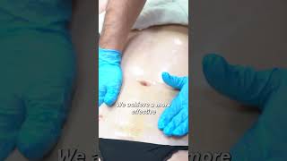 Lymphatic Massage After Surgery vanitycosmeticsurgery [upl. by Rehttam]