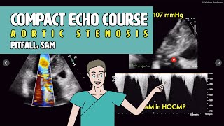 〖Echocardiography〗 LVOT obstruction amp SAM  pitfalls in aortic stenosis 🚨 [upl. by Aretahs]