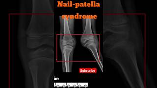 Nailpatella syndrome  Knee xray shorts radiology kneedisease [upl. by Aryam]