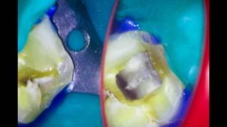 MANDIBULAR 2ND MOLAR ROOT CANAL WITH ONE FLARE AND 2 SHAPE [upl. by Chesna]