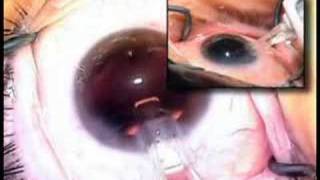 cataract surgery IOL insertion Uday Devgan MD lens implant [upl. by Okechuku483]