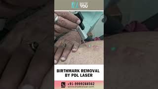 Birthmark Removal by PDL Laser  Pulsed Dye Laser Treatment in Delhi  Dr PK Talwar [upl. by Annagroeg807]