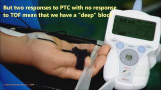 4Neuromuscular monitoring TOF amp PTC during surgery [upl. by Nanji]