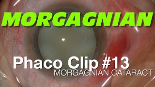 Phaco Clip 13  Morgagnian Cataract [upl. by Adnawuj578]