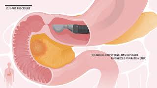 EUS endoscopic ultrasound FNB amp Intervention Animation amp explanation [upl. by Kissel]