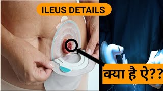 understanding ILEUS [upl. by Shimberg]