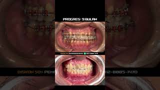 behel orthodontist kawatgigi [upl. by Godfry]