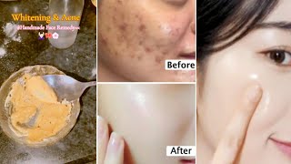 Whitening face mask  acne mask remedy  Homemade face remedy [upl. by Wendy]