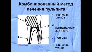 1350 Хирургические методы лечения пульпита [upl. by Alrak]