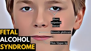 Fetal Alcohol Syndrome Causes Signs and Symptoms Diagnosis and Treatment [upl. by Ynneh]