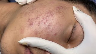 ACNE TREATMENT VU QUYNH MI Acne On Boys Chin 2024 [upl. by Eelah]