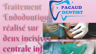 DÉVITALISATION DENTAIRE  Toutes les étapes dun Traitement Endodontique Dent antérieure [upl. by Justinn]