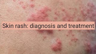 Skin Rash diagnosis and treatment [upl. by Eimmat40]