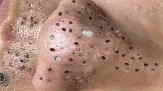 Blackhead Removal With Sac Dep Spa 1000341 [upl. by Photima371]