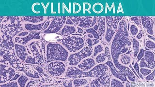 Cylindroma 5Minute Pathology Pearls [upl. by Etnomaj18]