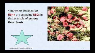 Thrombosis Embolisms Factor V Leiden Mutation Lymphedema Lymphadenitis and Cellulitis [upl. by Dimitri97]