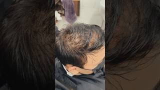 low density hair patch for men  hair transformation explore natural ytshorts delhi india [upl. by Anawqahs]