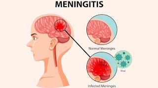 Meninges  Meningitis symptoms Diagnosis And Treatments [upl. by Clorinde]