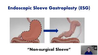 Endoscopic Sleeve Gastroplasty ESG  Procedure Overview [upl. by Amalie884]