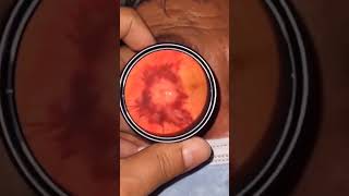 Papilledema disc edemashorts viral doctorofoptometry optometry education eye optometrist [upl. by Ozzy]