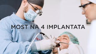 Most na 4 implantata Case study by dr Filip Štimac [upl. by Lorenza]