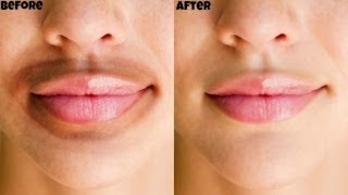 How To Remove Dark Black patches Dark SpotsHyperpigmentation Around Your Mouth  Elegant Rosy [upl. by Wurst838]