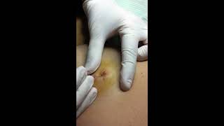 Sebaceous Cyst Extraction [upl. by Aihsirt844]