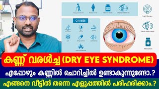 കണ്ണ് വരൾച്ച Dry Eye Syndrome  ഉണ്ടാകുന്ന ചൊറിച്ചിൽ വീട്ടിൽ പരിഹരിക്കാം  Causes and Symptoms [upl. by Annej366]