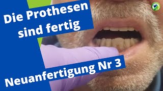 Neue Prothesen  Sprechprobe perfekter Saugeffekt Totalprothese Okklusion Remontage Tipps Tricks [upl. by Doreg]